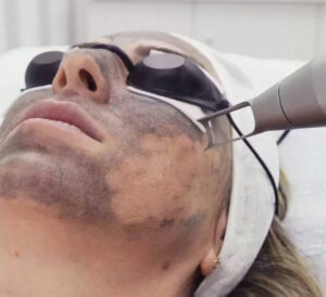 Bắn carbon là gì