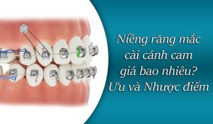 Niềng răng mắc cài cánh cam giá bao nhiêu