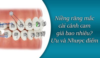 Niềng răng mắc cài cánh cam giá bao nhiêu