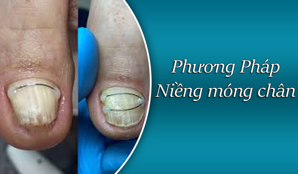 Phương pháp niềng móng chân bị quặp